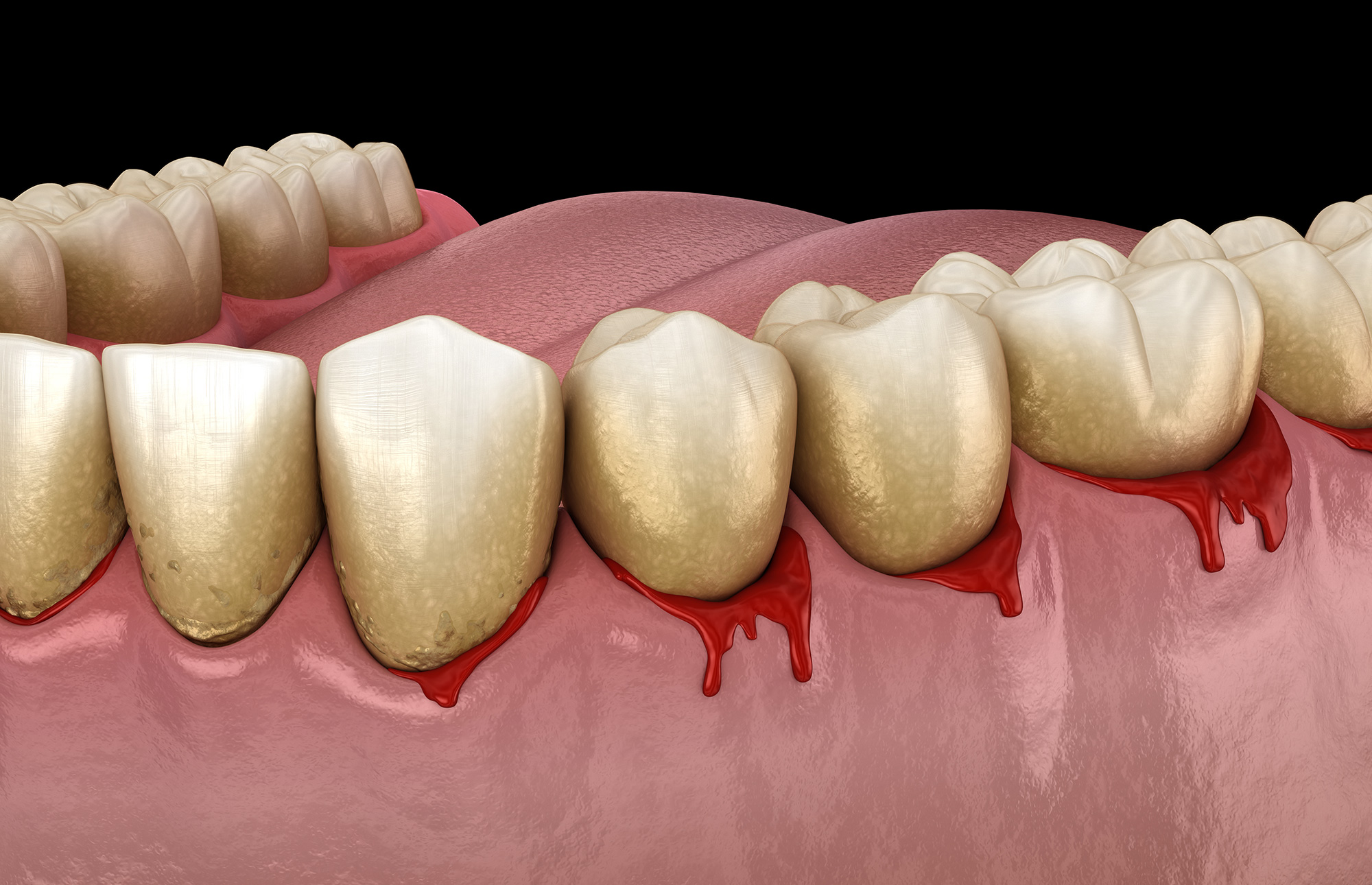 Chảy máu nướu: Nguyên nhân, phòng ngừa và cách điều trị hiệu quả