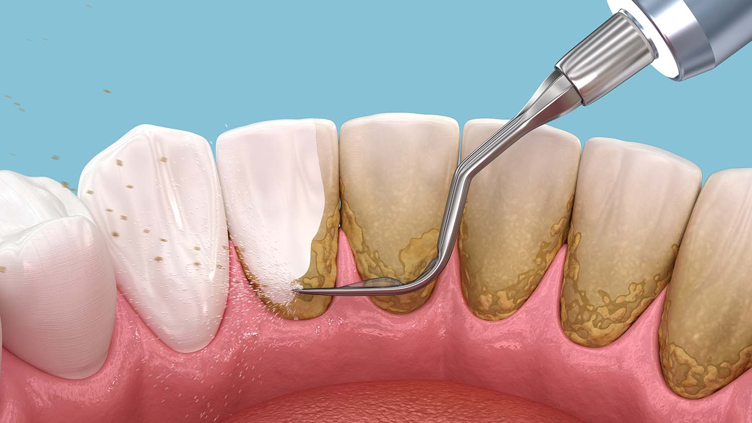 Lấy cao răng: Tại sao đây là một bước quan trọng trong việc chăm sóc răng miệng?