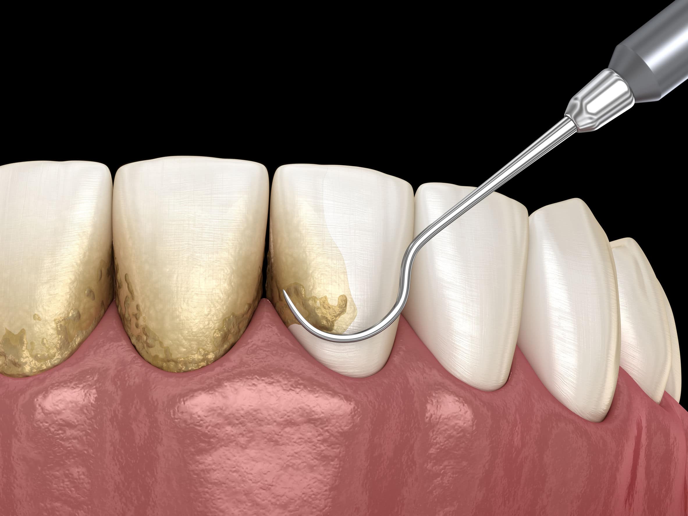 Lấy cao răng: Tại sao đây là một bước quan trọng trong việc chăm sóc răng miệng?