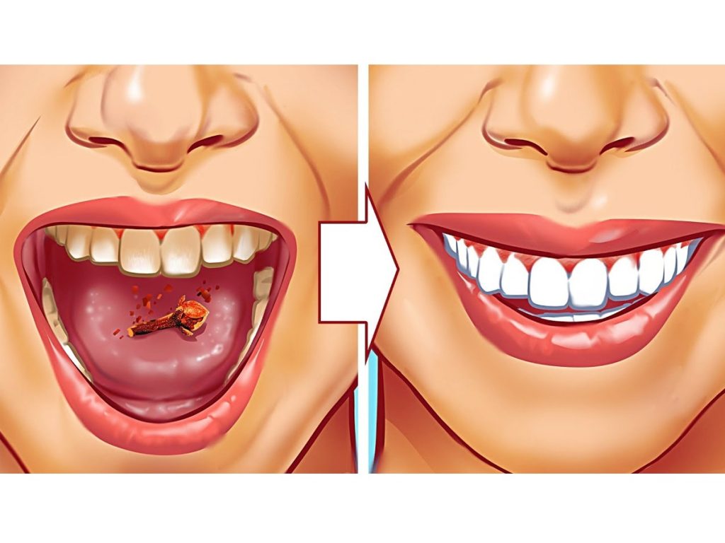 Lấy cao răng: Tại sao đây là một bước quan trọng trong việc chăm sóc răng miệng?