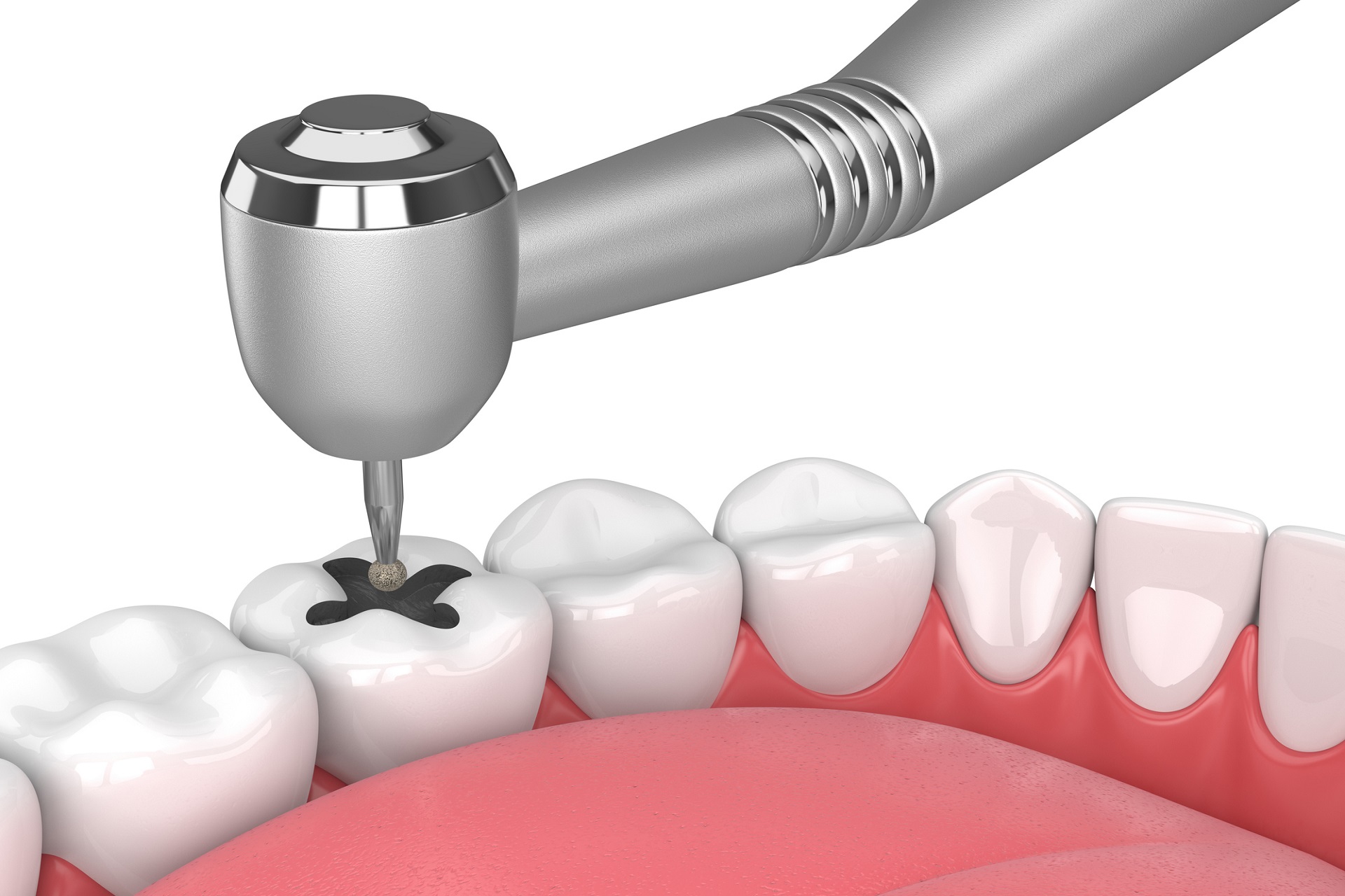 Vật liệu trám răng Amalgam: Lợi ích, rủi ro và tương lai