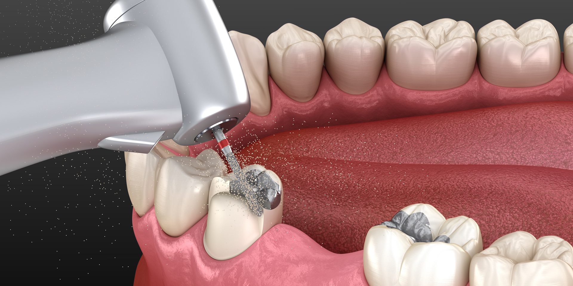 Vật liệu trám răng Amalgam: Lợi ích, rủi ro và tương lai