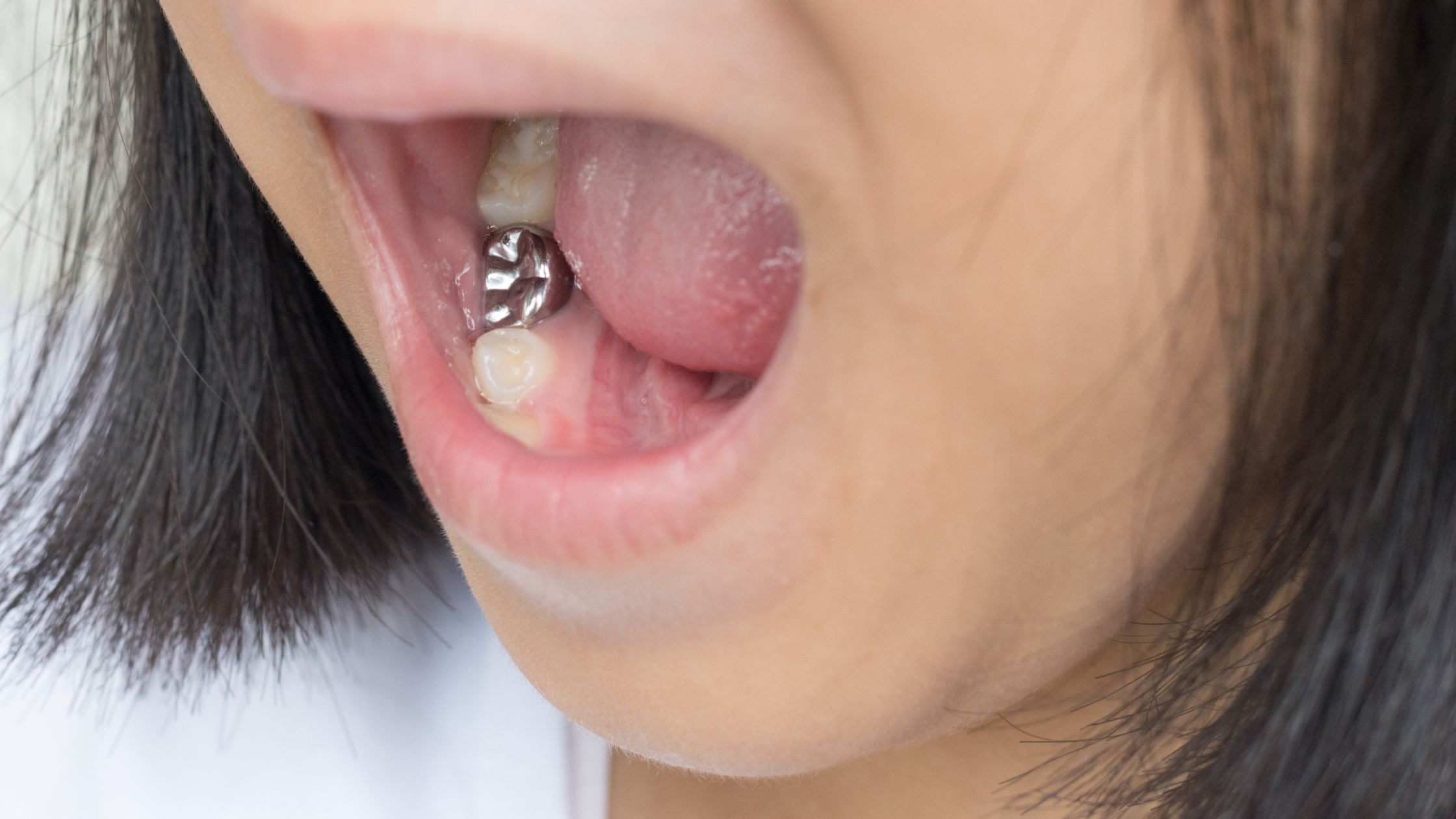 Vật liệu trám răng Amalgam: Lợi ích, rủi ro và tương lai